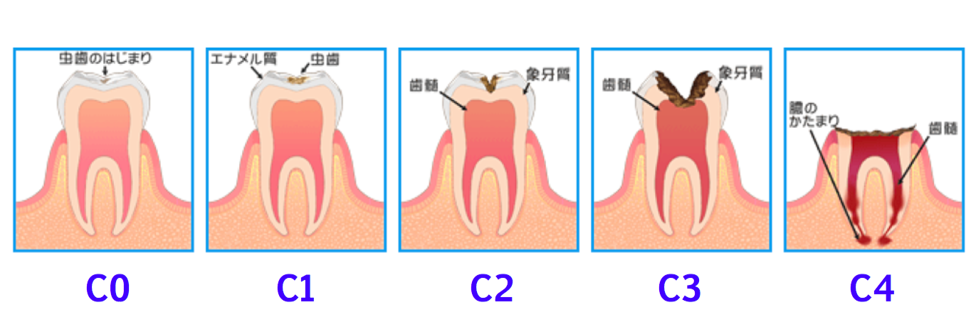 虫歯の程度について