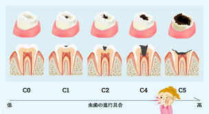 虫歯の程度について